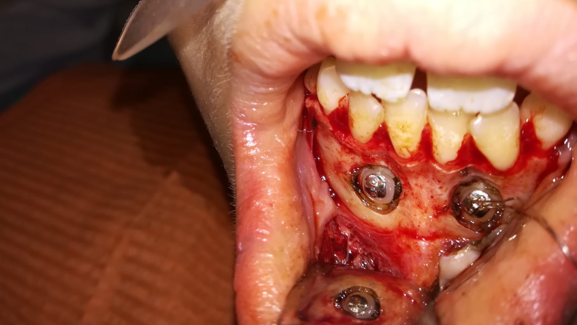 DENTI INCLUSI NELLA SINFISI MANDIBOLARE